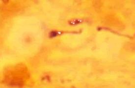 Lyme Disease Co-Infections