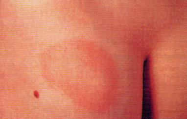 LYMEPOLICYWONK: How many of those with Lyme disease have the rash? Estimates range from 27-80%.