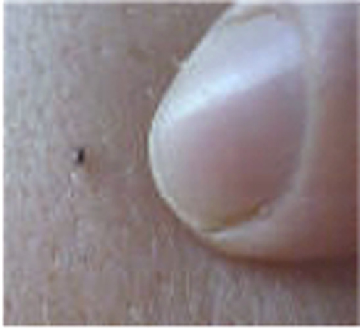 PRESS RELEASE: Tiny Ticks are on the Prowl