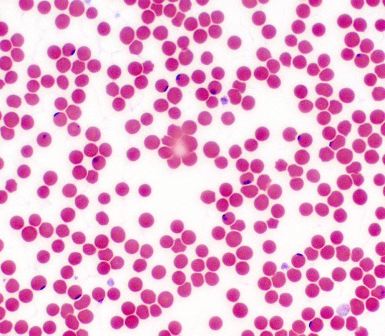 LYMEPOLICYWONK: Ticks Transmit a World of Disease and Co-infections Into the Lives of Lyme Patients