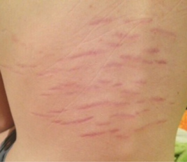 CDC identifies new species of Bartonella in humans