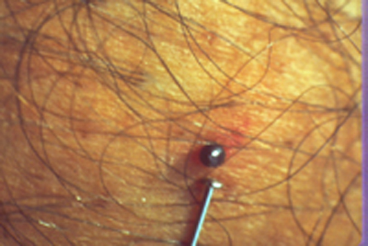 Help! A Tick Bit Me!