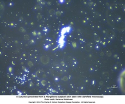 Studies show that infections–not delusion–cause Morgellons disease