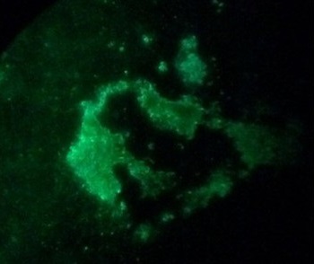 Seven provocative findings on Lyme disease, brains and placentas