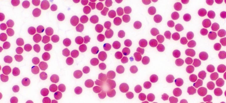 babesia