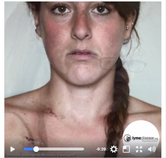 Watch and share Fox5NY’s “Faces of Lyme” PSA