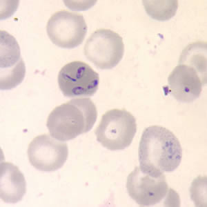 FDA approves first test to screen for Babesia in US blood supply