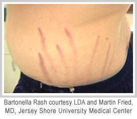 Investigating connections between Bartonella and psychiatric conditions