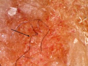 Study illustrates strong links between Morgellons and Lyme disease