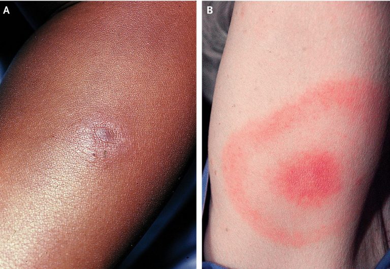 UCLA research: Signs of Lyme often missed in dark-skinned people