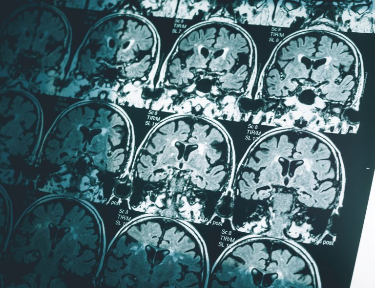 Could an 80-year-old drug cure Alzheimer’s disease?