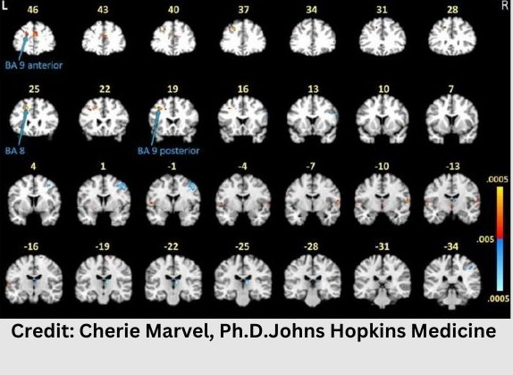 Distinct brain differences in those with chronic Lyme disease