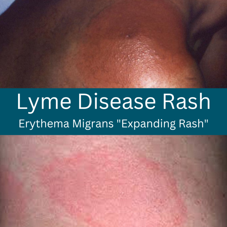 A Lyme rash doesn’t always look like a bull’s-eye target