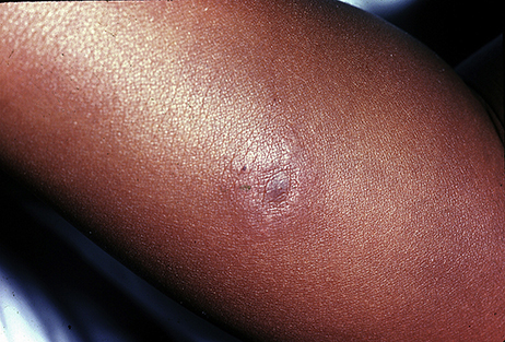 Racial disparities in diagnosis and treatment of Lyme disease