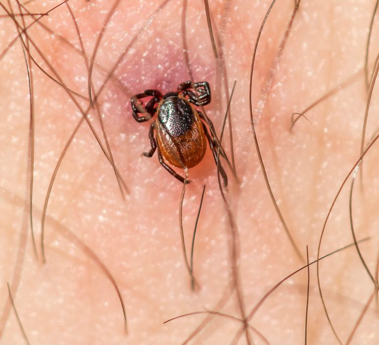 NASEM examines treatment for chronic illness following Lyme disease