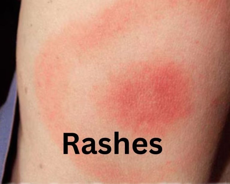 MEDICAL DETECTIVE #3: Let’s Talk About Lyme Rashes