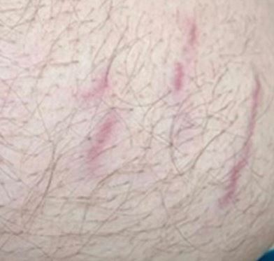 MEDICAL DETECTIVE: The complex role of Bartonella in chronic illness, part 1