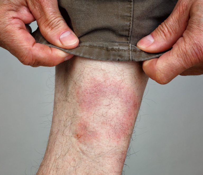 Piperacillin kills Lyme bacteria in mice, leaves gut microbiome alone