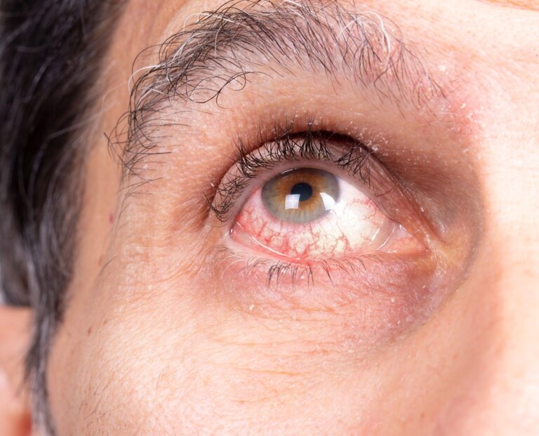 Study identifies uveitis as most common Lyme-related eye problem
