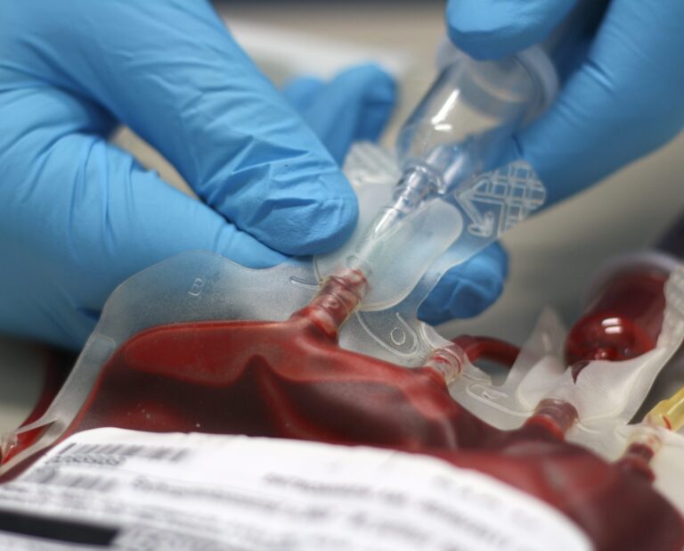 Exchange transfusion proves beneficial in severe babesiosis